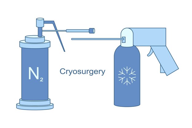 Sicurezza e precisione nella criochirurgia: guida alla sclelta dell’apparecchio ideale